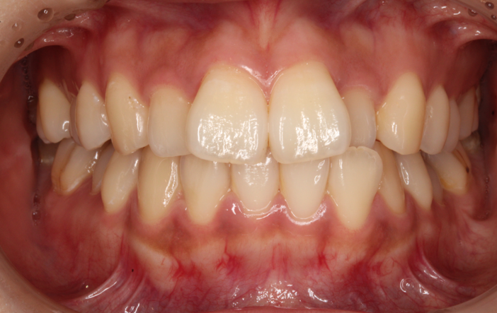 前歯の凸凹・裏側矯正・部分矯正の症例