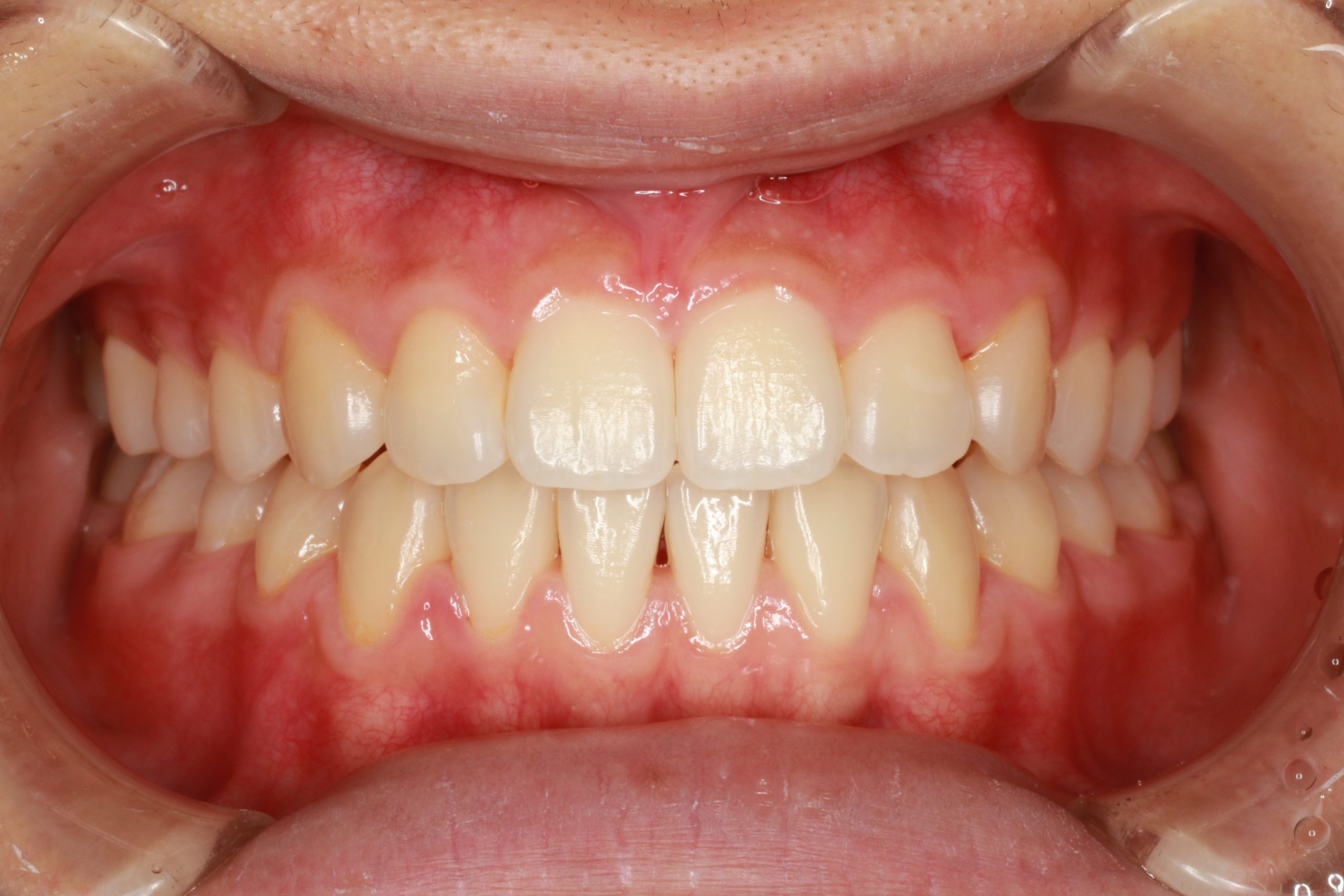 開咬・裏側矯正の症例