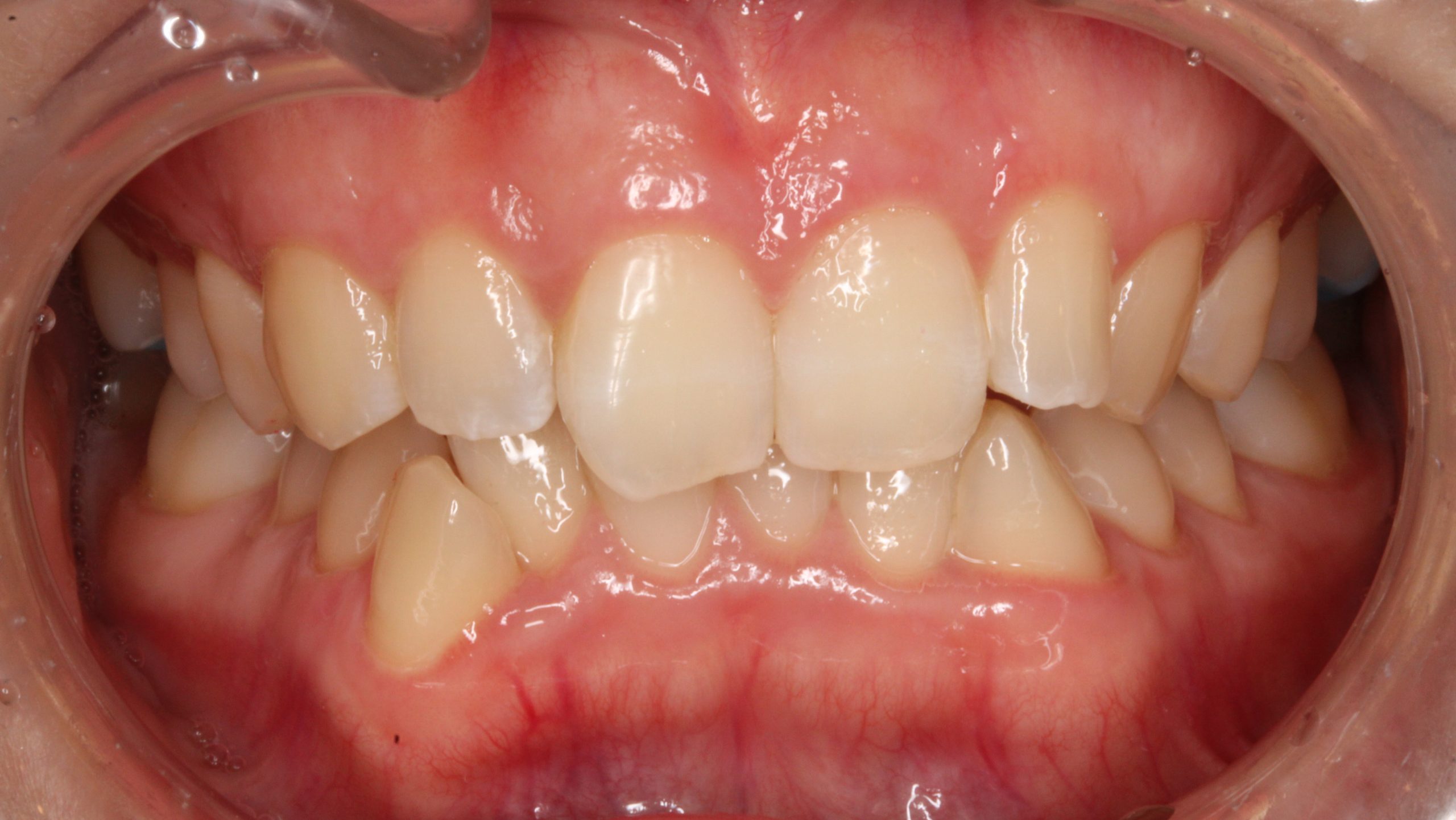 前歯のガタツキ・叢生・裏側矯正の症例