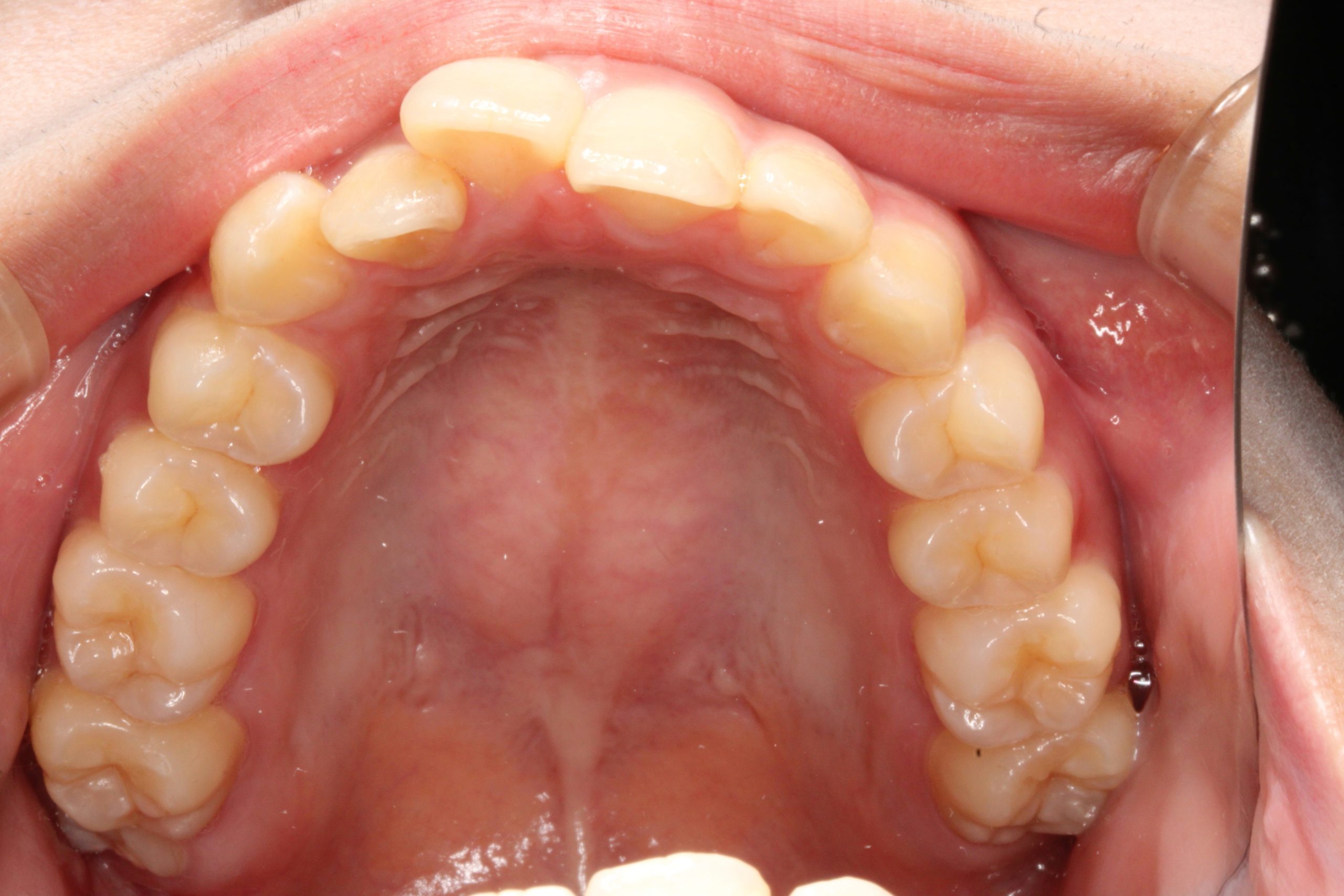 歯並びが凸凹している・ハーフリンガルの症例