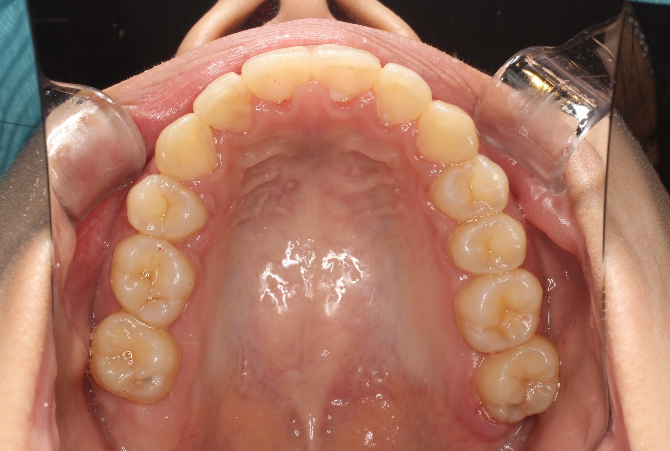 歯並びが凸凹している・ハーフリンガルの症例