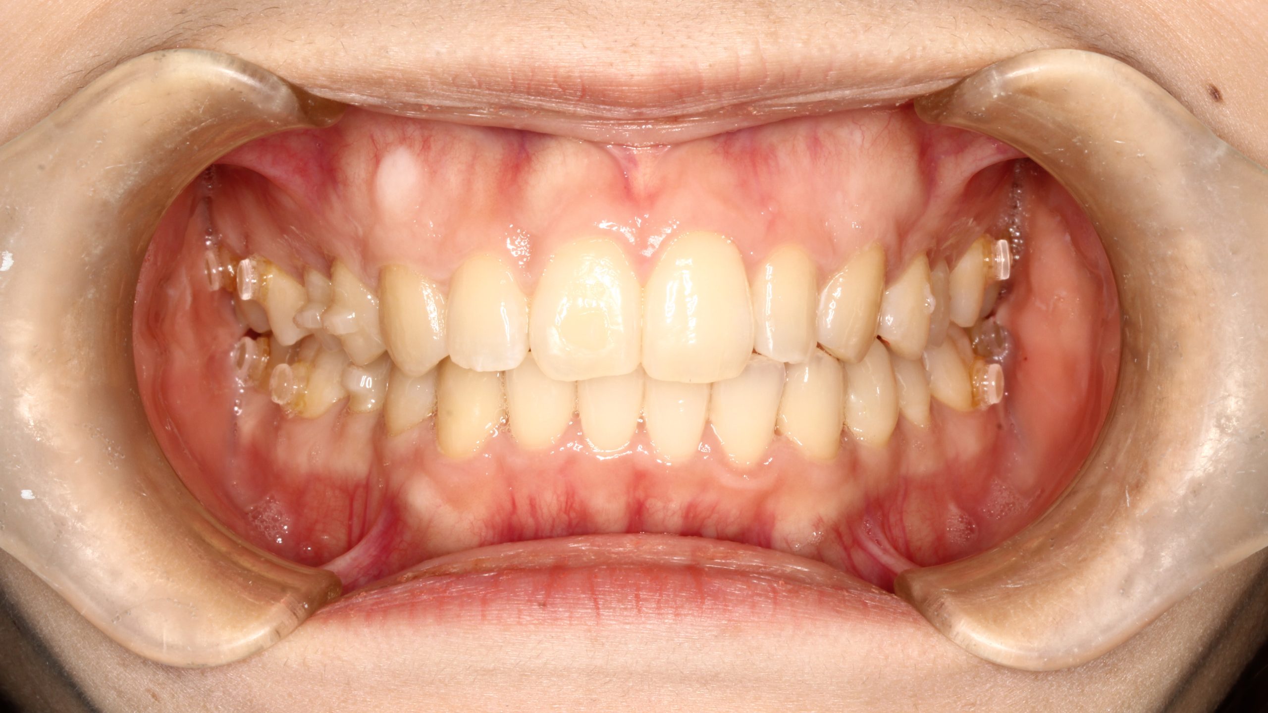 前歯のガタツキ・叢生・裏側矯正の症例