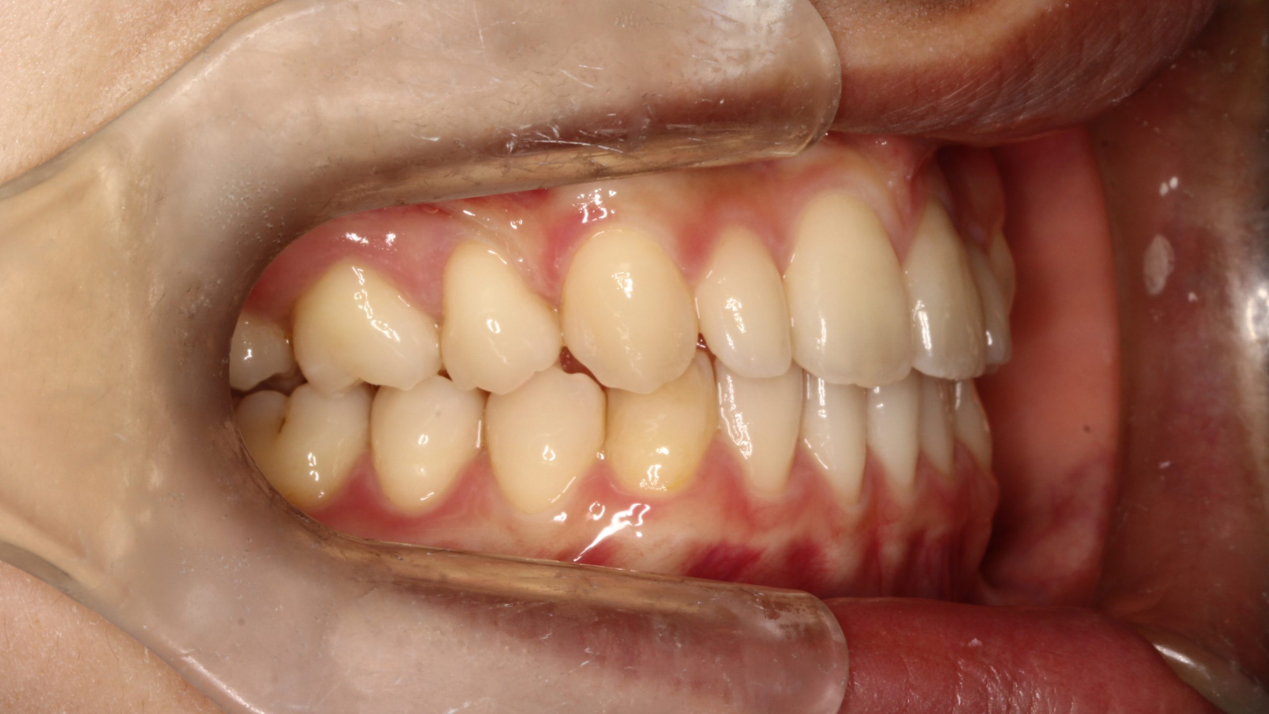 出っ歯・嚙み合わせ悪い・裏側矯正の症例