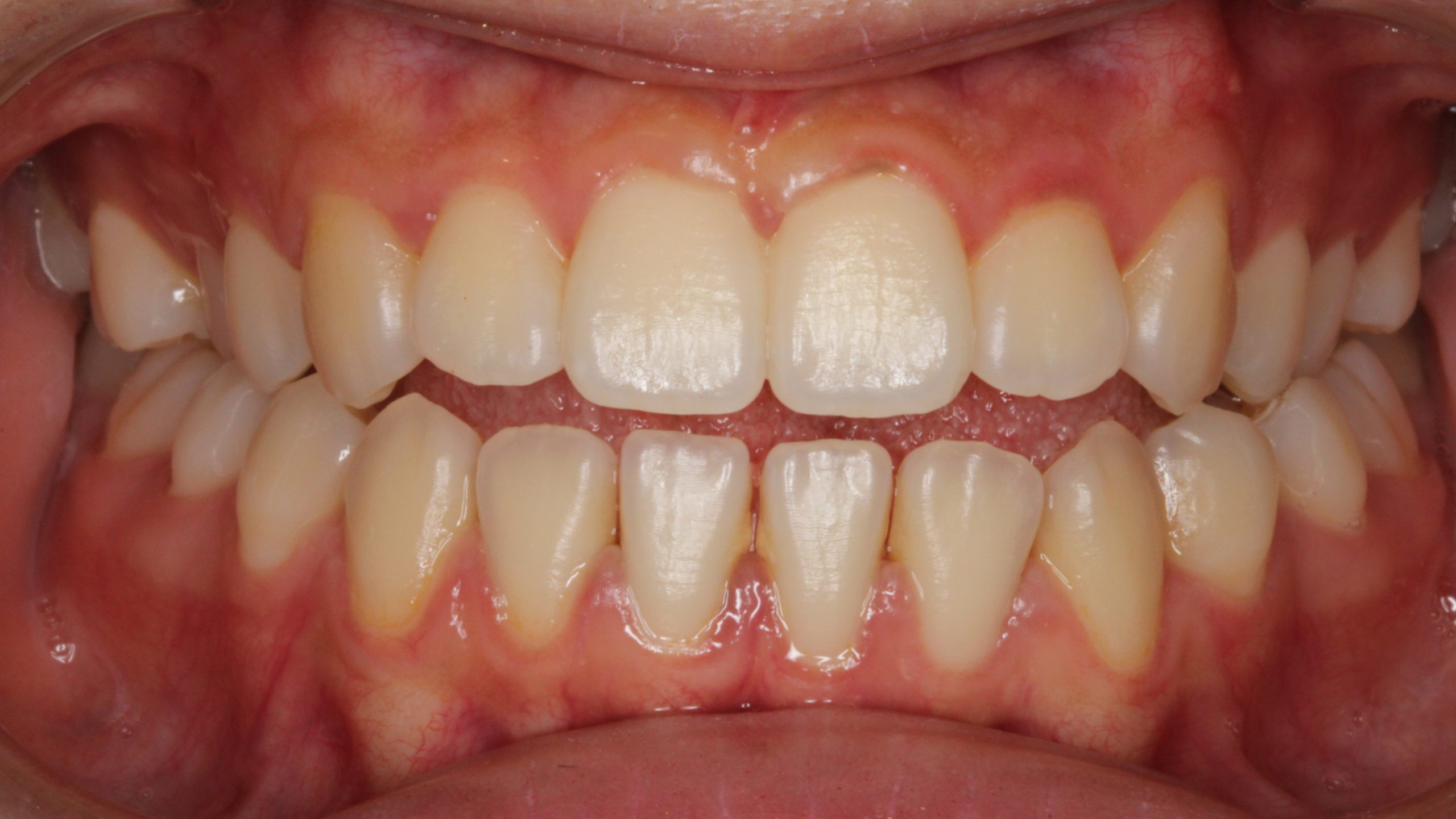 開咬・裏側矯正の症例