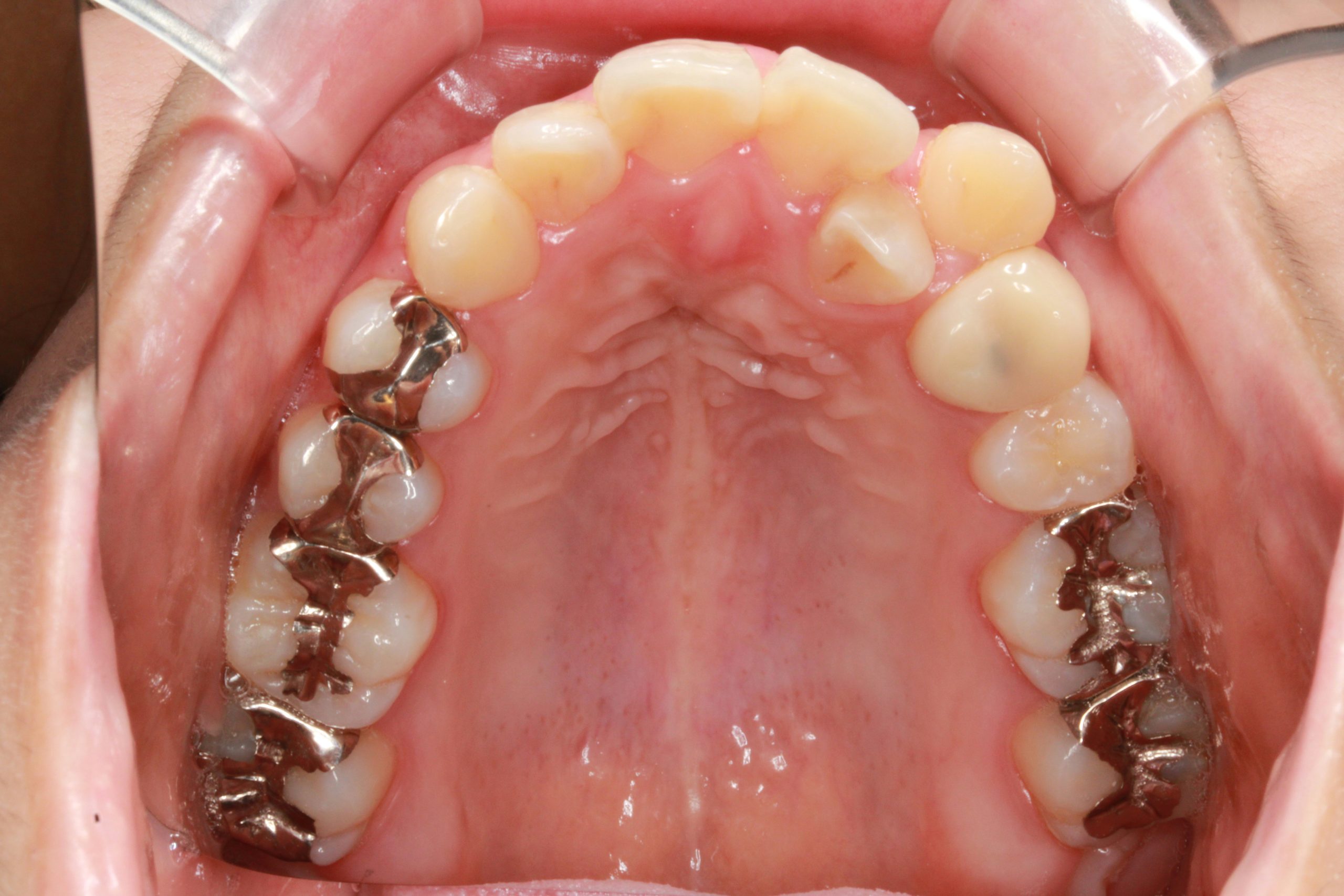 前歯の凸凹・八重歯・裏側矯正の症例