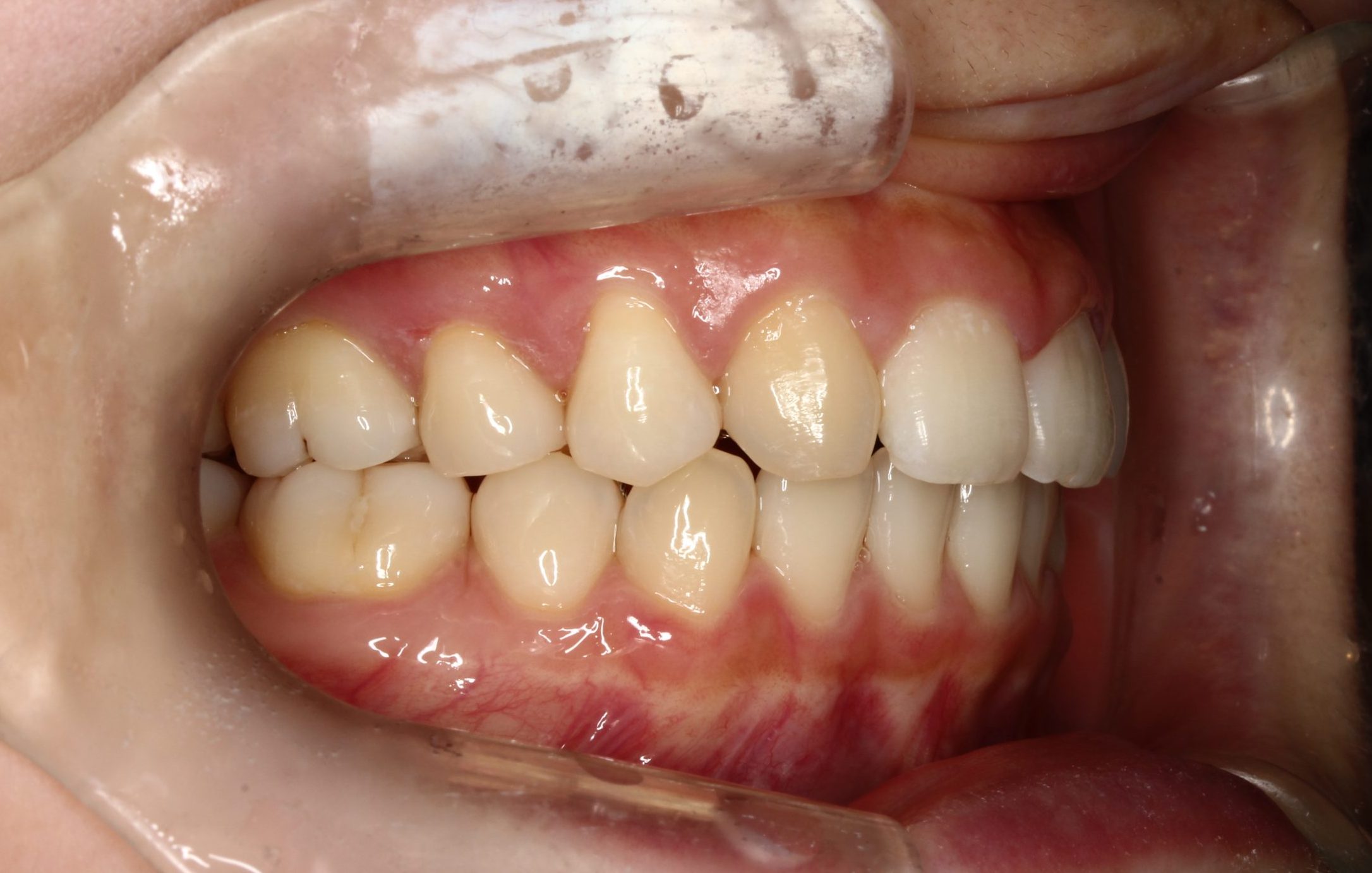 歯並びの凸凹・噛み合わせ合わない・裏側矯正の症例