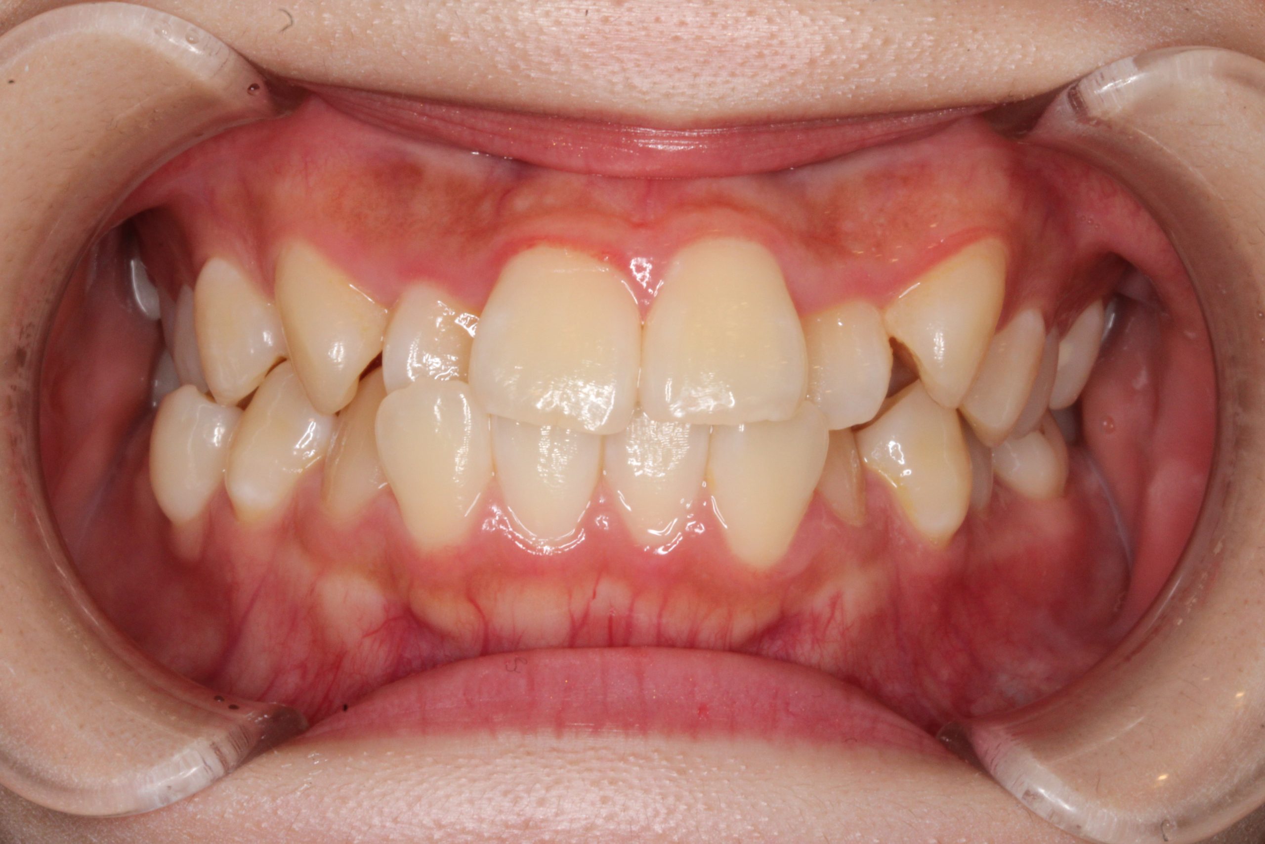 八重歯・Eライン整えたい・ハーフリンガルの症例