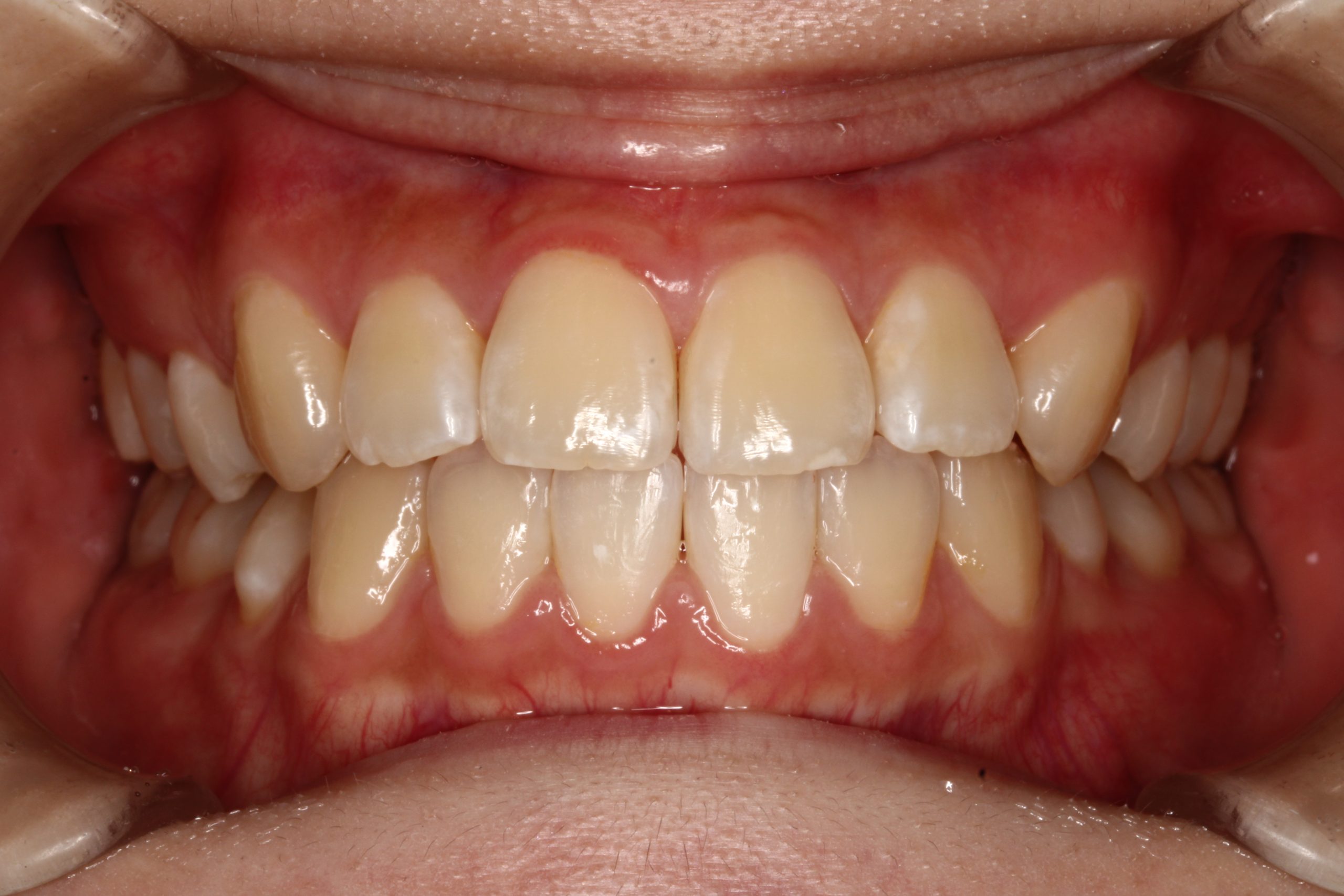 八重歯・Eライン整えたい・ハーフリンガルの症例