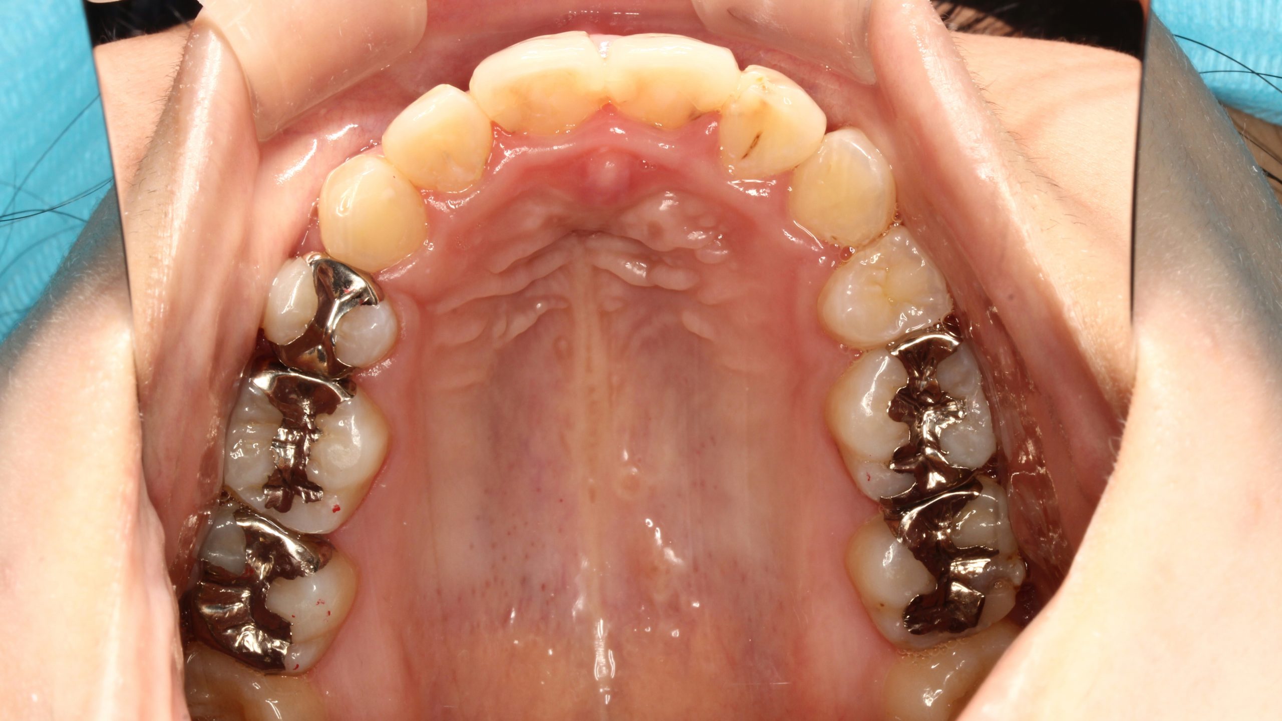前歯の凸凹・八重歯・裏側矯正の症例