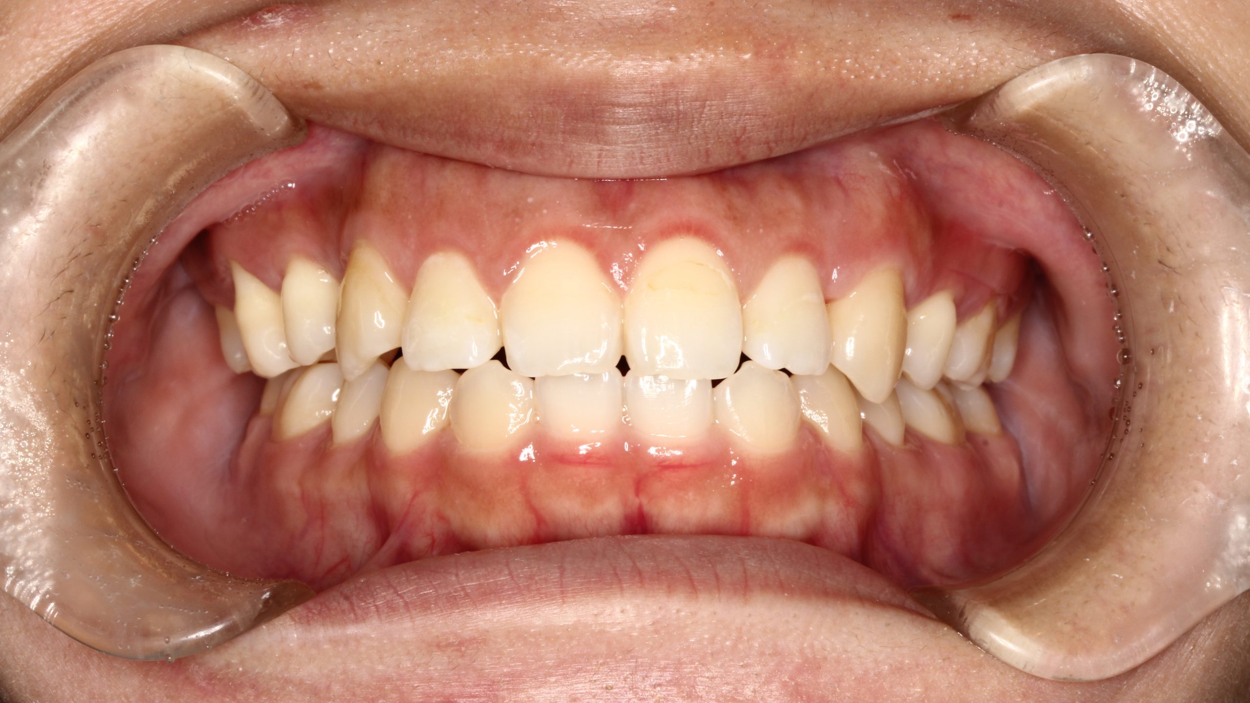 叢生・歯並び凸凹・裏側矯正の症例