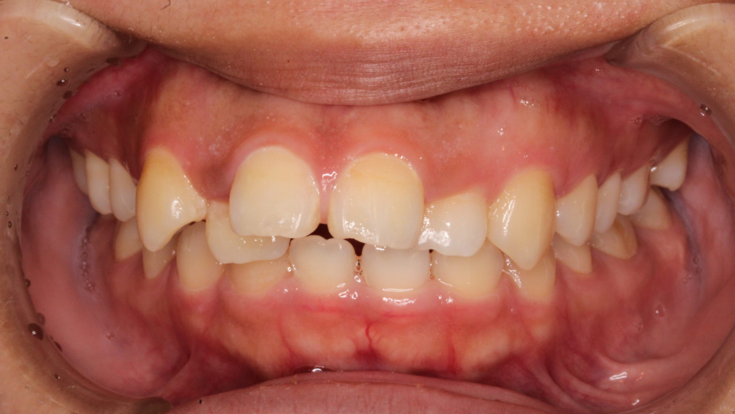 叢生・歯並び凸凹・裏側矯正の症例