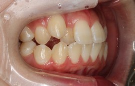 八重歯・裏側矯正の症例