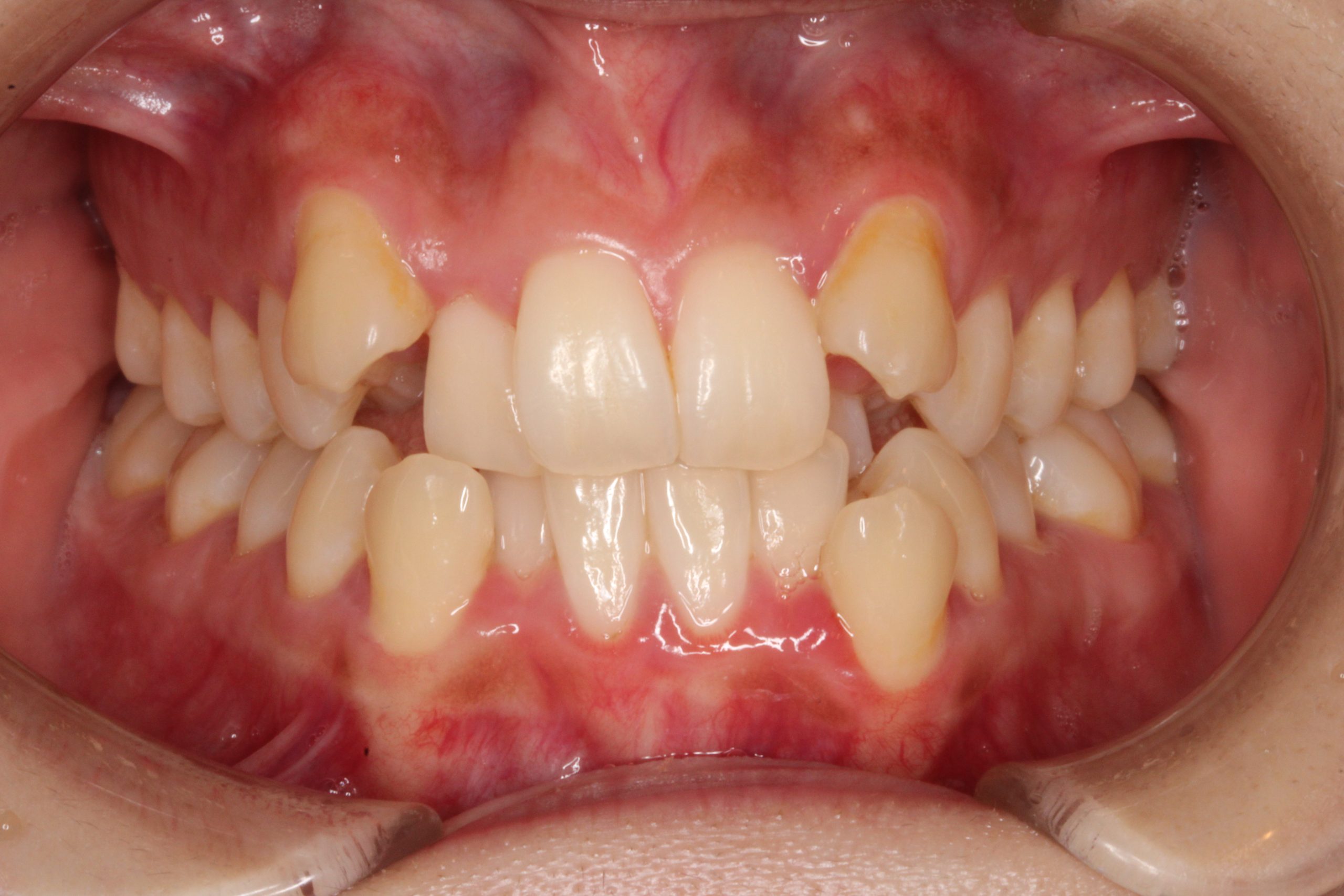 前歯の凸凹・裏側矯正の症例