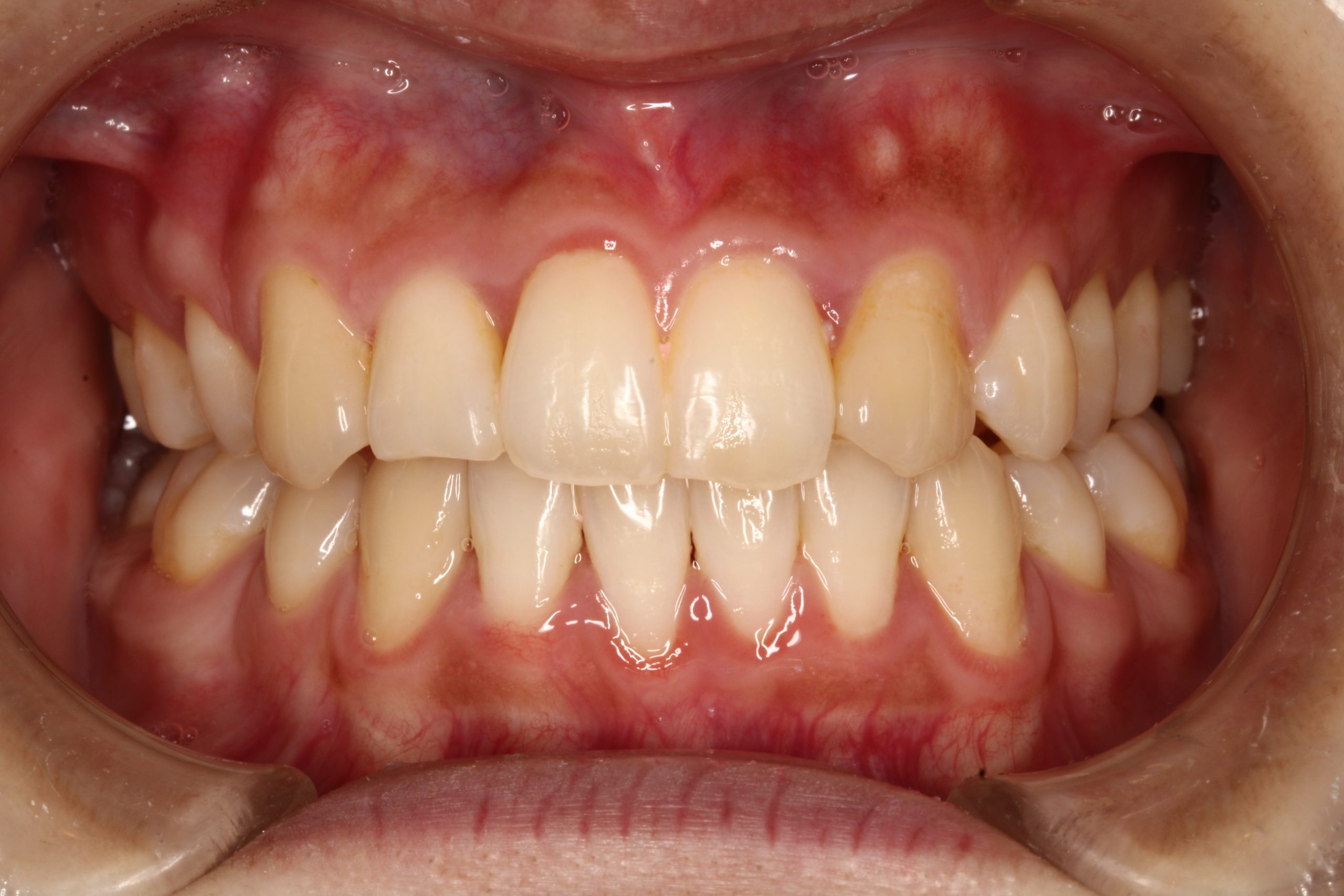 前歯の凸凹・裏側矯正の症例