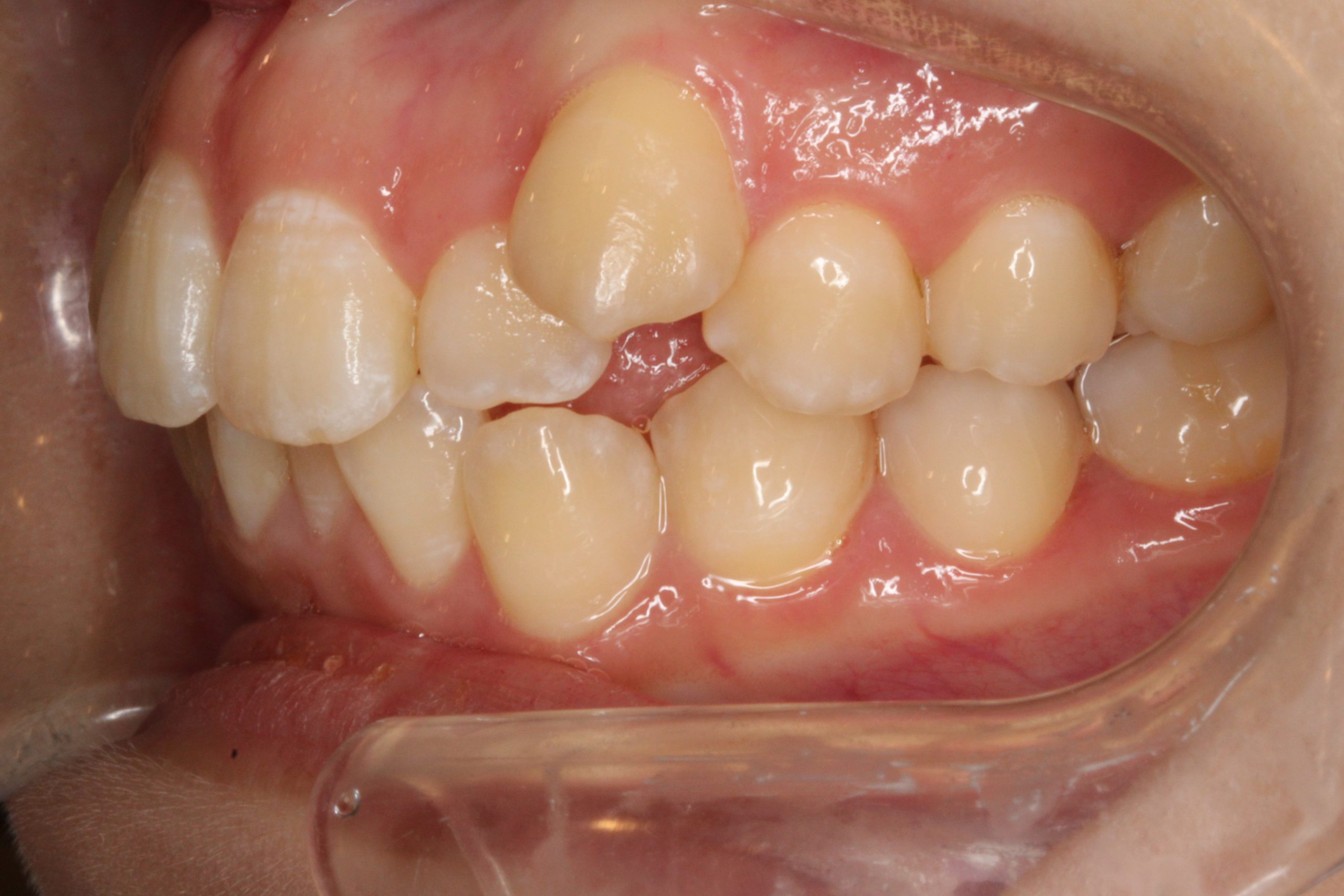 八重歯・嚙み合わせ治したい・正中合わせたい・ハーフリンガルの症例