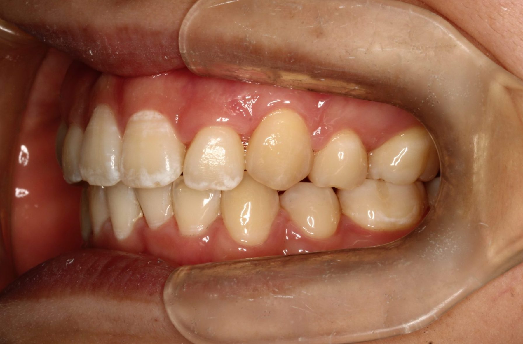 八重歯・嚙み合わせ治したい・正中合わせたい・ハーフリンガルの症例
