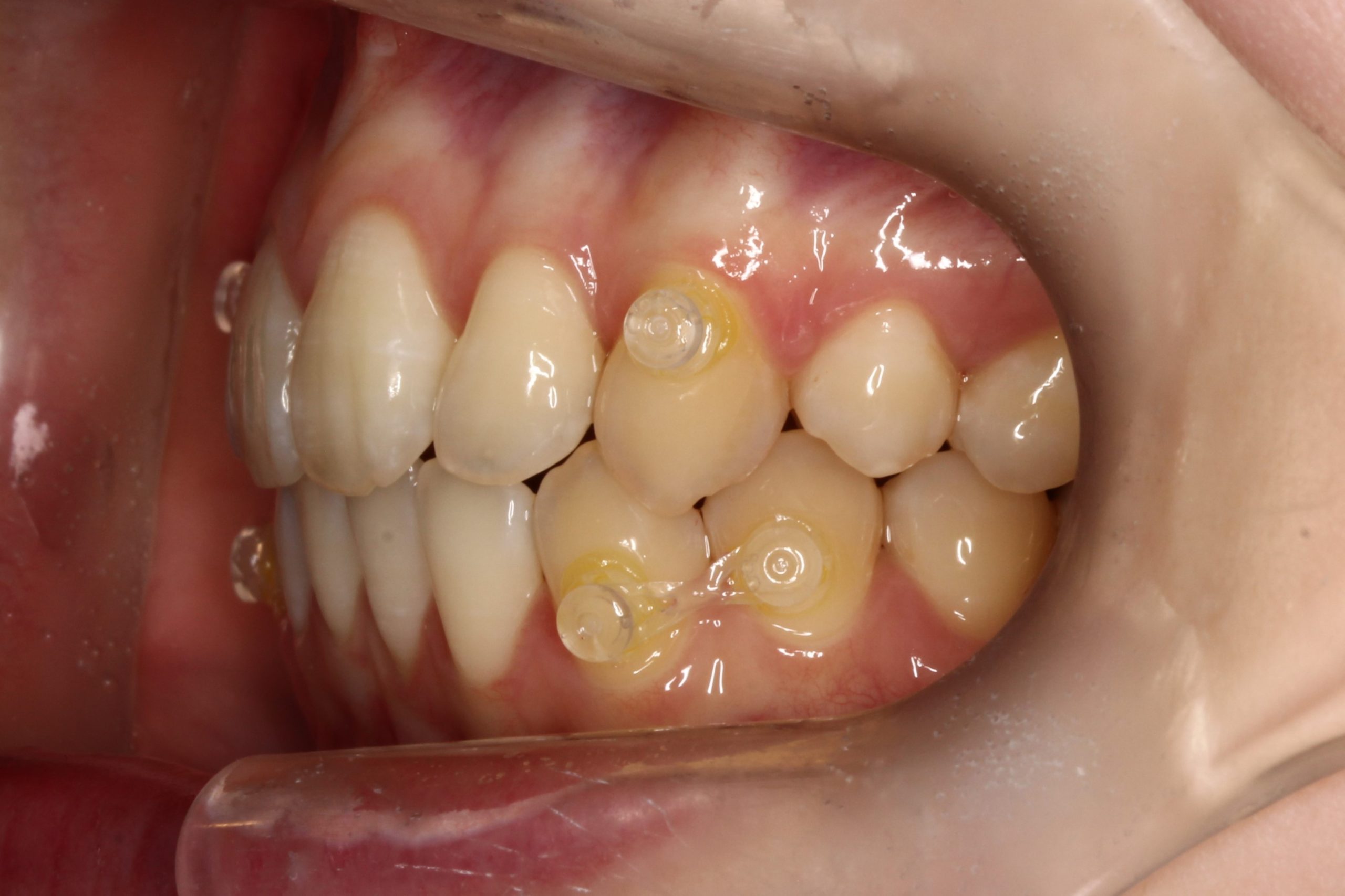 左上1番目の歯出ている・左上3番目の歯捻じれている・裏側矯正の症例