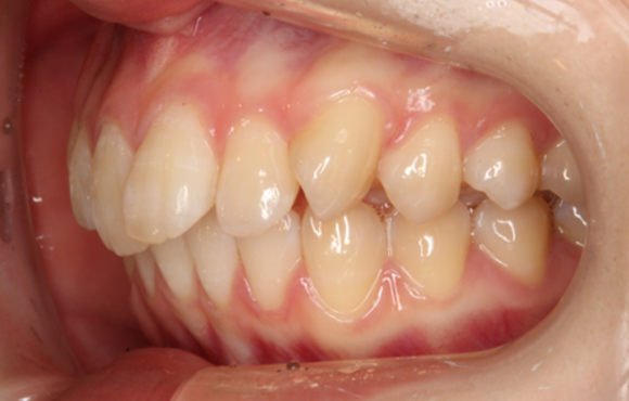 左上1番目の歯出ている・左上3番目の歯捻じれている・裏側矯正の症例